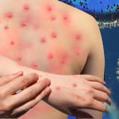 Monkeypox 