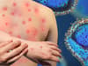 Monkeypox Greater Manchester: first case found in Wigan -symptoms to look out for