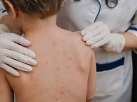 Chickenpox is a viral infection that mostly affects children, although you can get it at any age