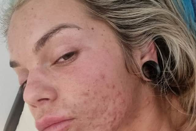 Sarah Hutchinson suffered from chronic acne Credit: SWNS