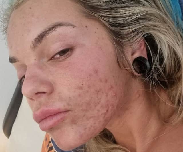 Sarah Hutchinson suffered from chronic acne Credit: SWNS