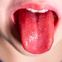 Here is the number of scarlet fever cases recorded in Greater Manchester, last week. 
