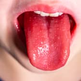 Here is the number of scarlet fever cases recorded in Greater Manchester, last week. 