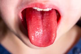 Here is the number of scarlet fever cases recorded in Greater Manchester, last week. 