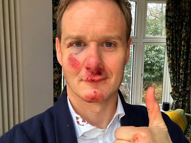 Dan Walker says he has no memory of the crash which left him bloody and bruised. Credit: Dan Walker