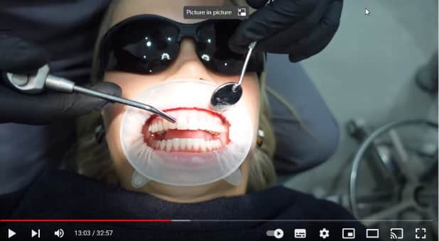 Molly-Mae Hague receiving her composite bonding procedure.
