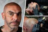 Anthony Donnellan, 44, opted for 'scalp micro-pigmentation' - instead of a traditional hair transplant - when his hair began to fall out.