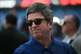 Noel Gallagher is going to need surgery 