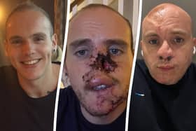 Ben Horne, who lost his nose when his dog ripped it off while trying to save him from a seizure has undergone ten reconstructive surgeries - using bones from his ribs.