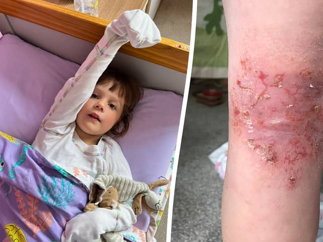 Emilia had to wear mittens for three years because her skin became 'addicted' to steroid cream. 