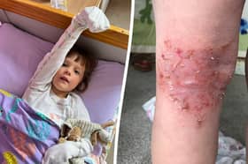 Emilia had to wear mittens for three years because her skin became 'addicted' to steroid cream. 