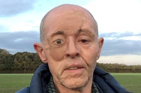 Graeme Heward's temporary prosthetic. 