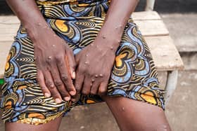 A woman infected with Mpox shows her arms at the Kamenge University Hospital's Mpox treatment centre in Bujumbura on August 22, 2024. (Photo: TCHANDROU NITANGA/AFP via Getty Images)