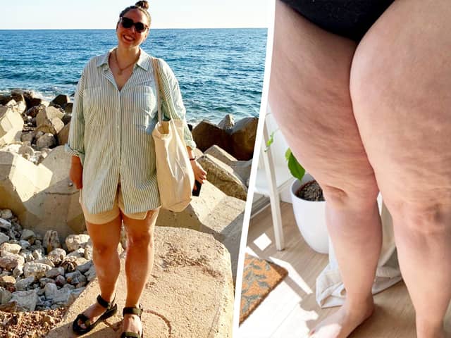 Rebecca Hickson wearing shorts (L) and her thighs (R). 