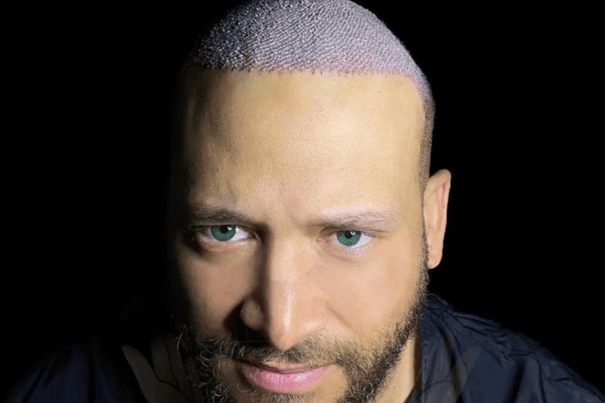 Aslı Tarcan Clinic is a leading destination for anyone considering hair transplant procedure in Turkey