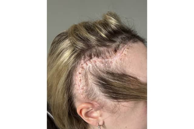 Holly Worswick hit the headlines after a routine eye check revealed a grapefruit-sized mass on her brain - despite claiming her GP blamed symptoms on her contraceptive pill. Surgeons removed it three days later but the 26-year-old has since battled skull infections and the benign tumour regrowing 'to the size of a grape' twice in the past two years