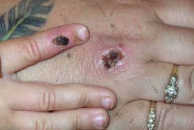 Symptoms of one of the first known cases of the monkeypox virus are shown on a patient's hand. Picture: CDC/Getty Images