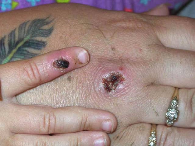 Symptoms of one of the first known cases of the monkeypox virus are shown on a patient's hand. Picture: CDC/Getty Images