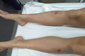 22-YEAR-OLD ROSIE GORMAN'S SHIN INJURY