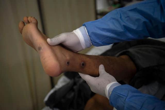 A doctor checks on a patient with sores caused by an mpox infection in 2022. (Photo by ERNESTO BENAVIDES/AFP via Getty Images)