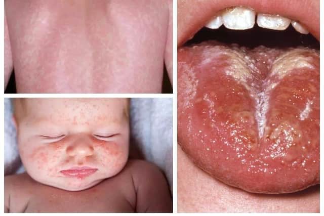 Scarlet Fever symptoms
