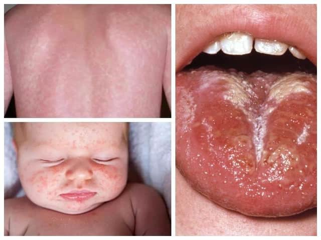 Scarlet Fever symptoms