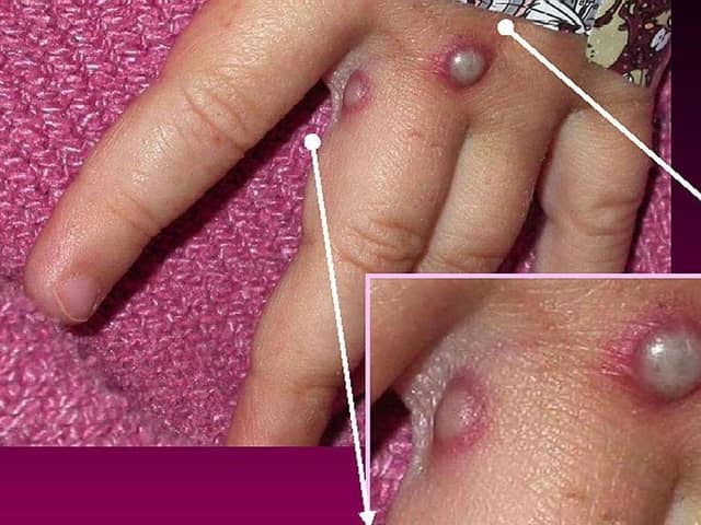 In this Centers for Disease Control and Prevention handout graphic, from 2003, symptoms of one of the first known cases of the monkeypox virus are shown on a patient's.(Photo: CDC/Getty Images)