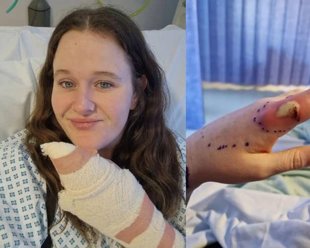 Crystal (left) and her left index finger just before her surgery.