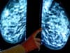 Thousands of Trafford women miss "vital" breast cancer screenings