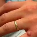 Monkeypox 