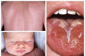 A rash and white coating on the tongue are among symptoms symptoms of scarlet fever Credit: NHS 